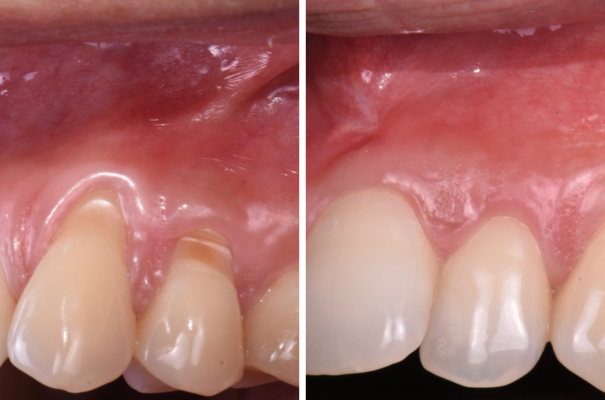 Connective Tissue Graft Narrative