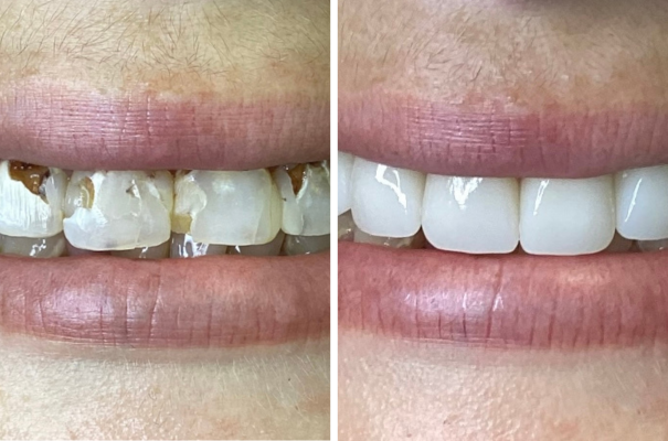 Cosmetic Full Mouth Before and after